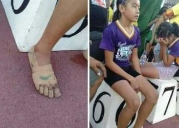 ضمادات طبية لقهر مسافات السباق