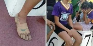 ضمادات طبية لقهر مسافات السباق