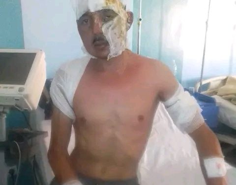 تالسينت(إقليم فكيك).. زوجة تحرق زوجها بالزيت المغلي((+ فيديو))